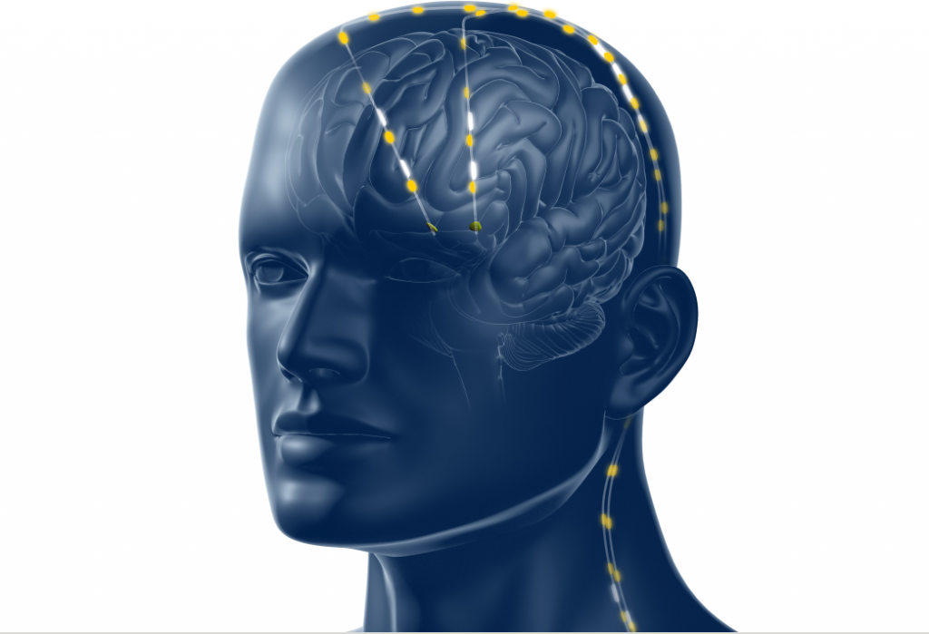 Neurochirurgen in het ETZ hebben als eerste in de Benelux een nieuwe generatie elektroden in het hoofd van een Parkinsonpatiënt ingebracht.