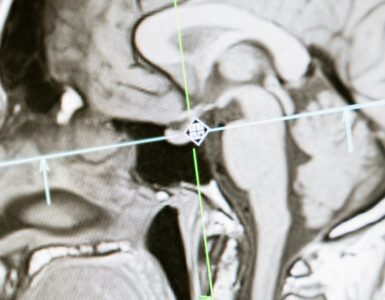 Het Gamma Knife Centrum van het Elisabeth-TweeSteden Ziekenhuis (ETZ) heeft een compleet nieuwe Gamma Knife (afbeelding ter illustratie) voor neurochirurgische behandelingen.